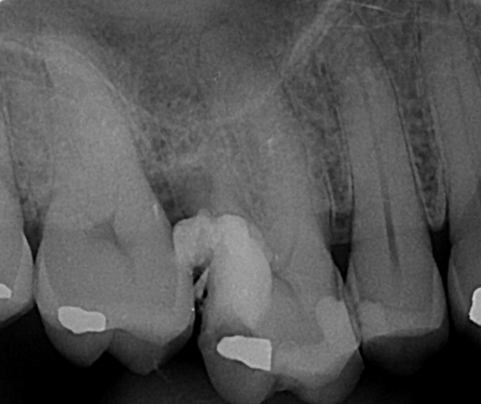 Radiografia antes do tratamento - dente condenado