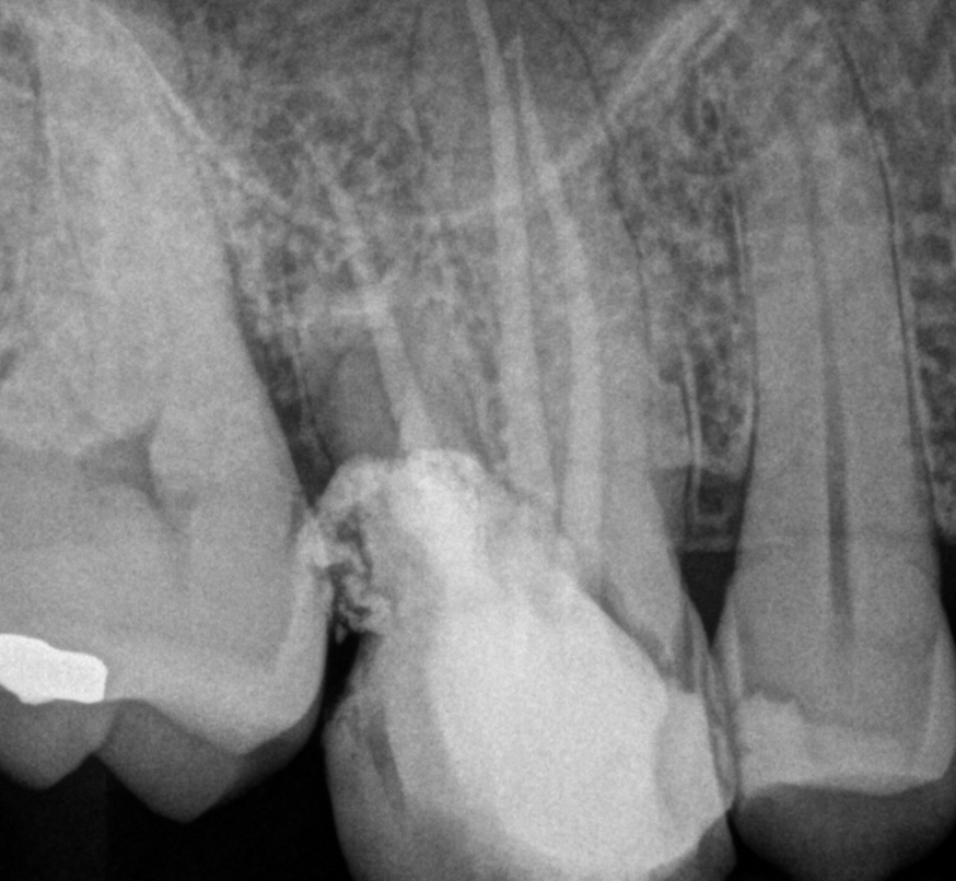 Radiografia depois do tratamento - dente recuperado