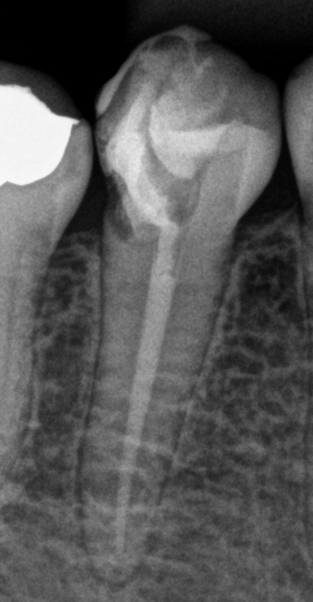 Radiografia depois do tratamento em sessão única