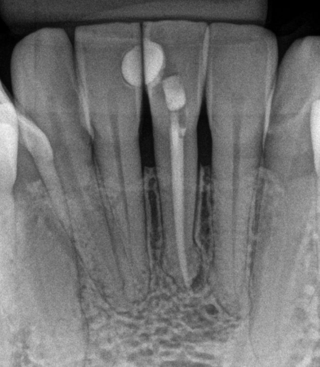 Radiografia depois do tratamento em sessão única